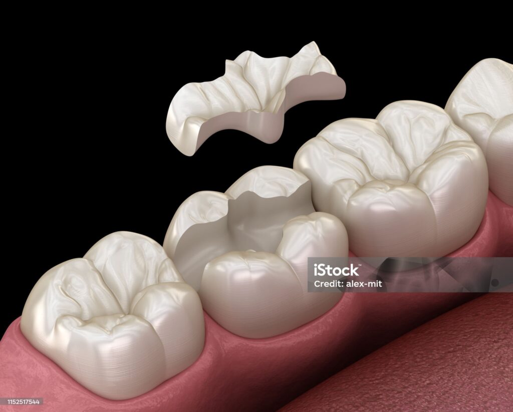 Intarsio Dentale
