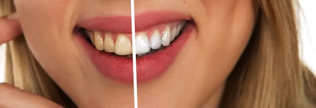 sbiancamento dentale sbiancamento dentale