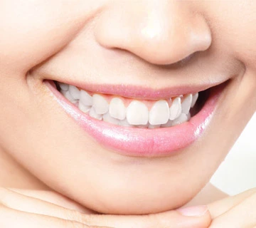 Sbiancamento Dentale: Perché è la Migliore Soluzione per un Sorriso Radiante 1 Sbiancamento dentale