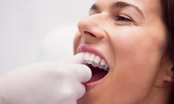 apparecchio denti invisibile
