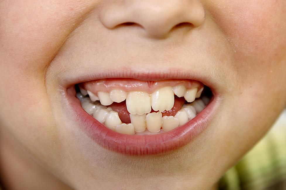 La trasformazione del sorriso: apparecchio denti prima e dopo l'apparecchio 2 denti storti