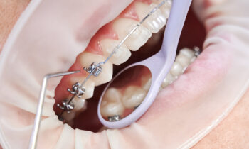 Adulto che indossa un apparecchio dentale esterno, mostrando i risultati positivi del trattamento ortodontico.