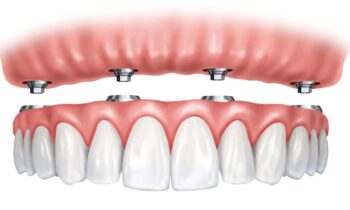 full arch impianto con 6