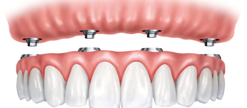 full arch impianto con 6